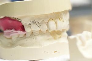 東松山でインプラント治療を希望する場合について